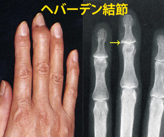 ヘバーデン結節